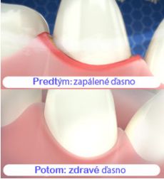 Zap&aacute;len&eacute; ďasno je mierne červen&eacute; a ustupuje. Z&aacute;pal ďasien sp&ocirc;sobuje aj odhaľovanie zubn&yacute;ch kŕčkov.